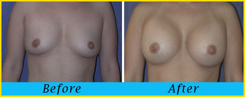 breast-augmentation-miami