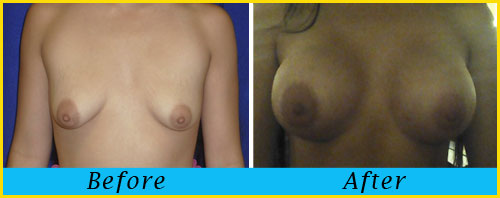 breast-augmentation-surgery-miami