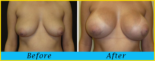 breast-augmentation3-miami