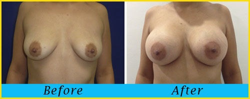 breast-augmentation6-miami