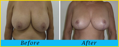 breast-reduction-miami
